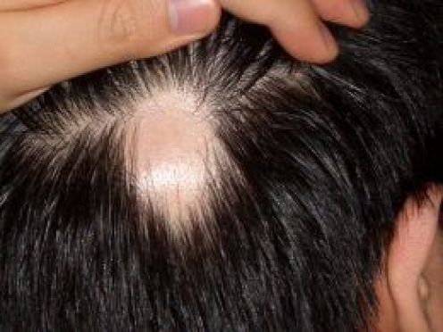 Alopesi areata (saçkıran)