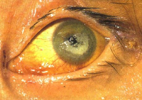 Şiddetli immün yetmezliği olan bir çocukta Candida'nın neden olduğu iki taraflı keratit
