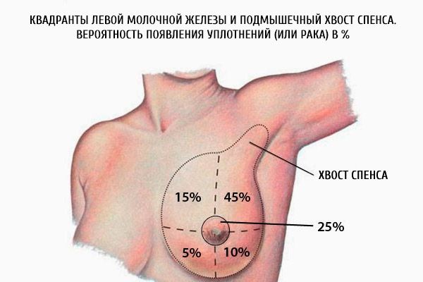 Sol memenin kadranları ve spentin aksiller ucu.  % Olarak mühürler (veya kanser) olasılığı