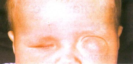 Kist oluşumuyla ilişkili mikroftalmos (sol göz). Anoftalmos (sağ göz).