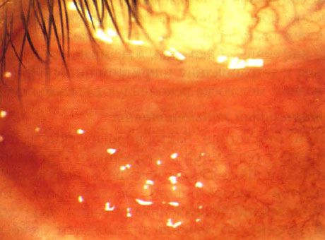 Molluscum contagiosum'un çoklu lezyonları olan bir çocukta akut foliküler konjonktivit