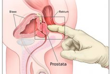 masaj prostata aparat