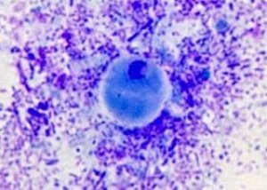 Blastocitoz Nedenleri Belirtileri Tani Tedavi Ilive De Saglik Konusunda Yetkin Bir Sekilde