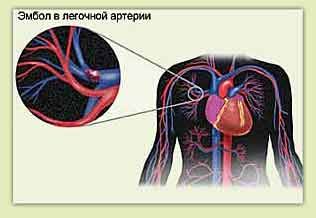 Solda pulmoner emboli ve göğüs ağrısı