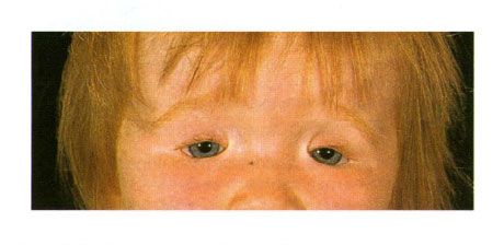 Golden sendromlu bir çocukta göz kapaklarının iki taraflı kolobomu.  Soldaki göz yarıklarının kapanması